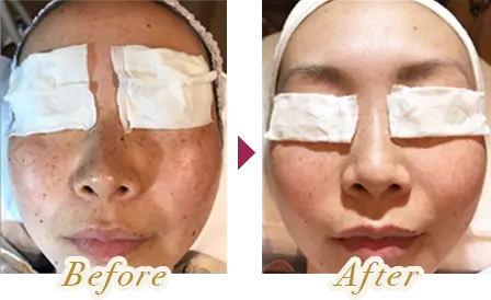E-lightでフェイシャルエステを受けた女性のビフォーアフター